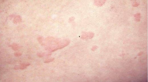 Alergias en la piel Urticarias Alergologo Malaga